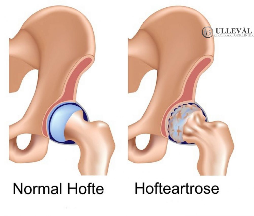 illustrasjonsbilde av anatomisk bilde av hofter med artrose