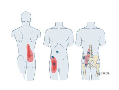 Image: <thrive_headline click tho-post-11972 tho-test-192>Psoas Major: Den mest misforståtte hoftebøyeren?</thrive_headline>