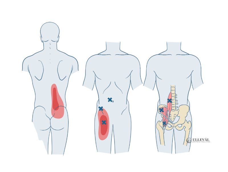 iliopsoas-muskelen og triggerpunkter