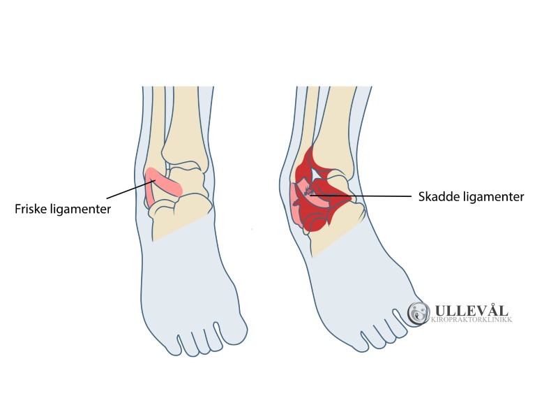 frisk ankel og en ankel med skadde leddbånd