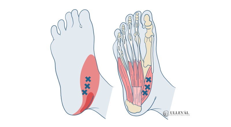 muskel som svekkes ved hallux valgus