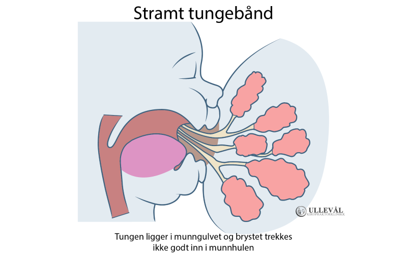 baby med stramt tungebånd som dier brystet til mor