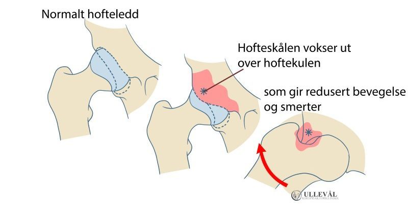 Hvordan pincer impingement utvikler seg i hoften