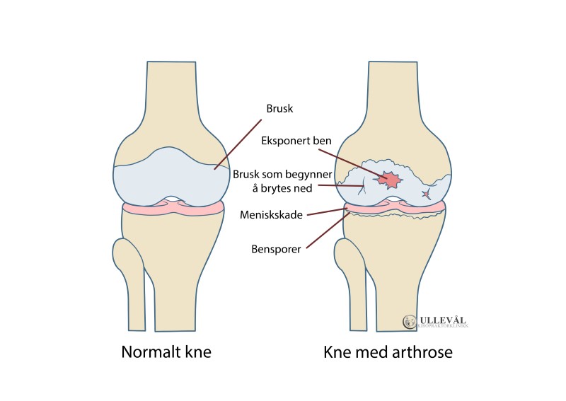 Normalt versus artrose kne