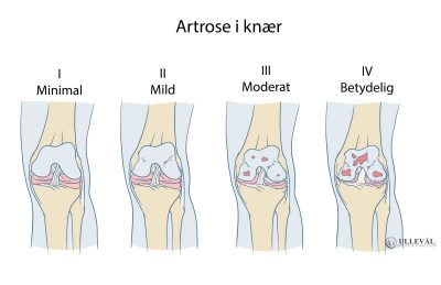 Image: Slitasje i knærne? | 5 grader av artrose