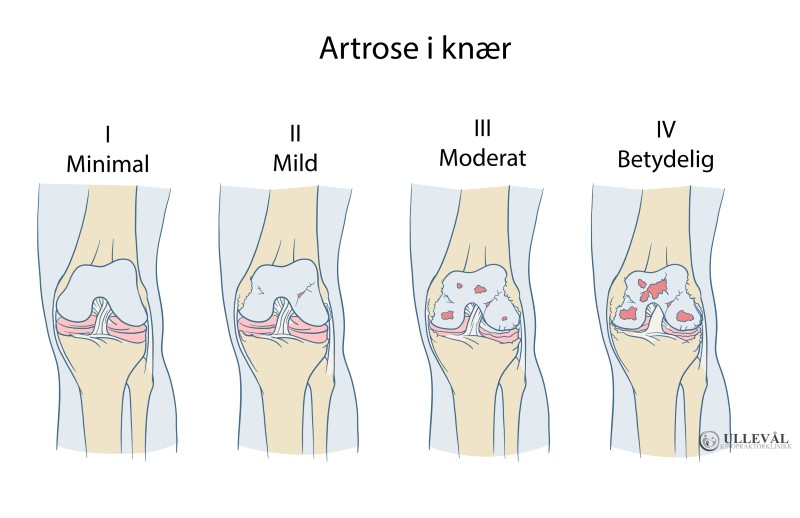 Artrose i knærne. Grad 1 til 4 av 5 grader