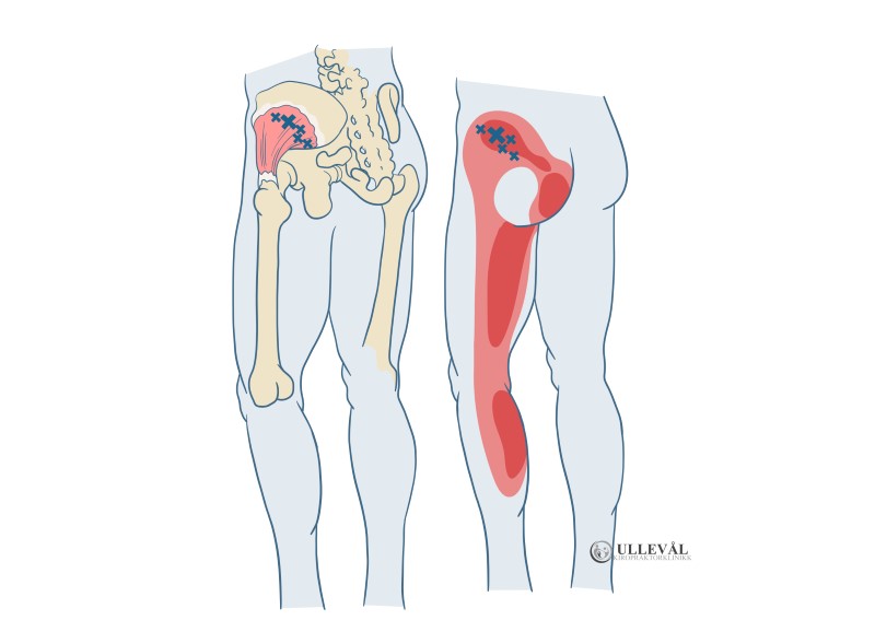 triggerpunkt i gluteus minimus