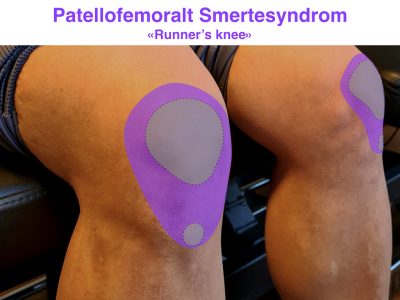 Image: Løperkne - Patellofemoral Smertesyndrom Forklart