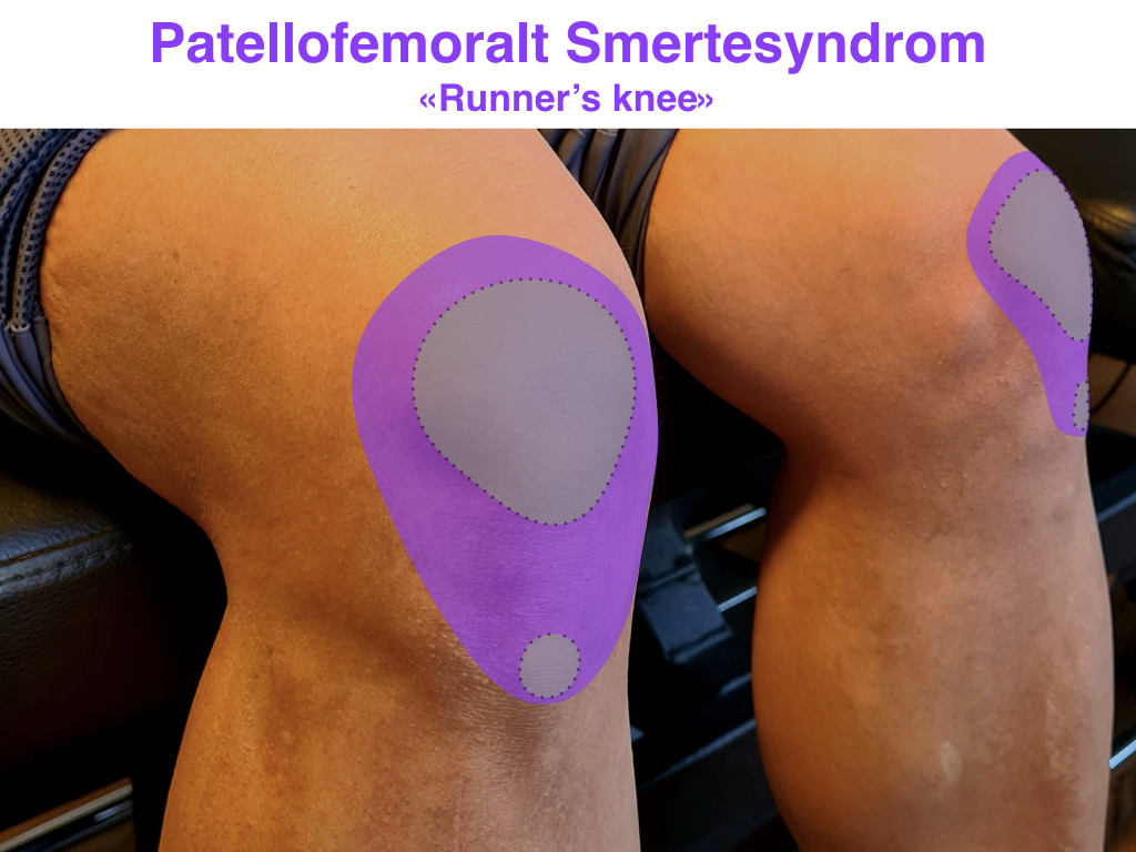 Patellofemoralt Smertesyndrom og knesmerter