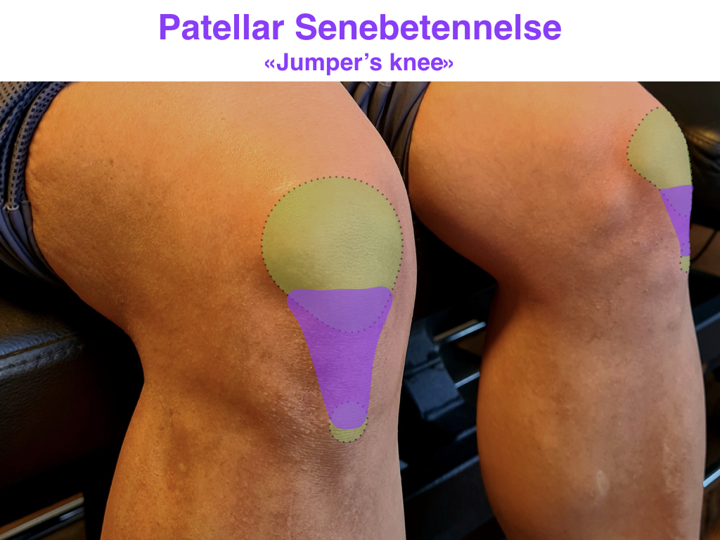 Patellar senebetennelse og knesmerter