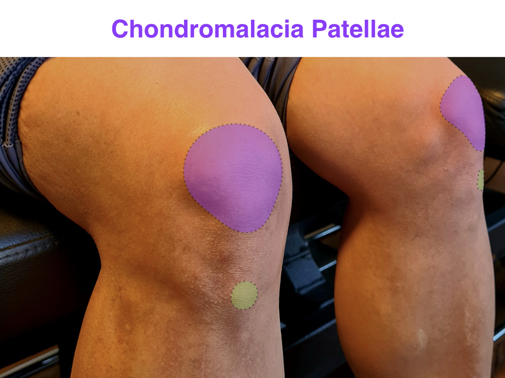 Chondromalacia Patella og knesmerter