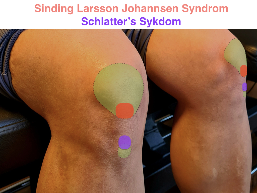 Sinding Larsson Johannsen Syndrom og Schlatter's Sykdom og knesmerter