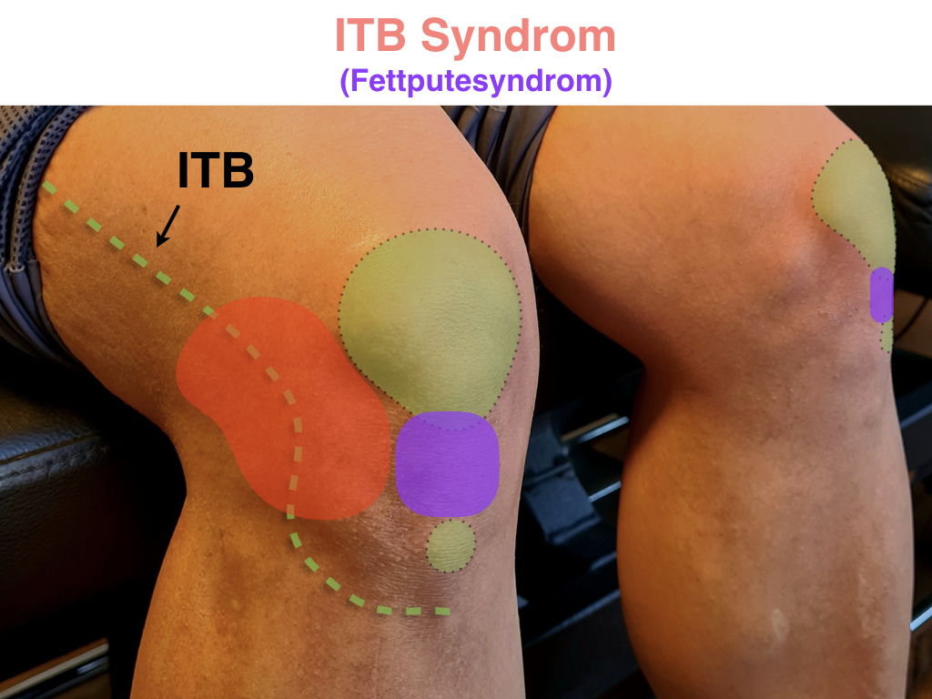 ITB syndrom