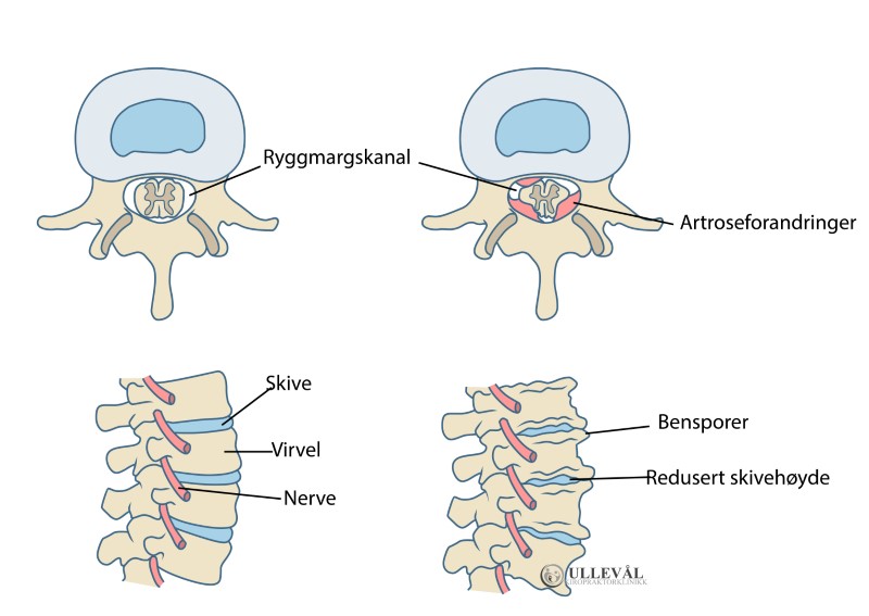 spinal stenose på grunn av slitasjeforandringer i ryggen