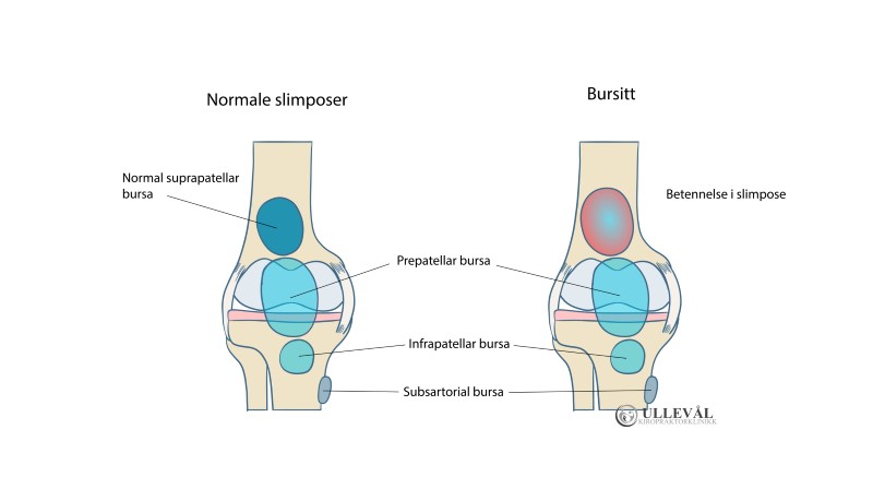 Bursae av kneet som kan gi smerter i fremre kne