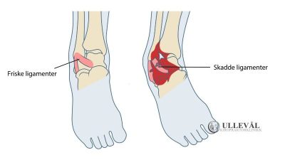 Image: Forstuet ankel – alt du trenger å vite