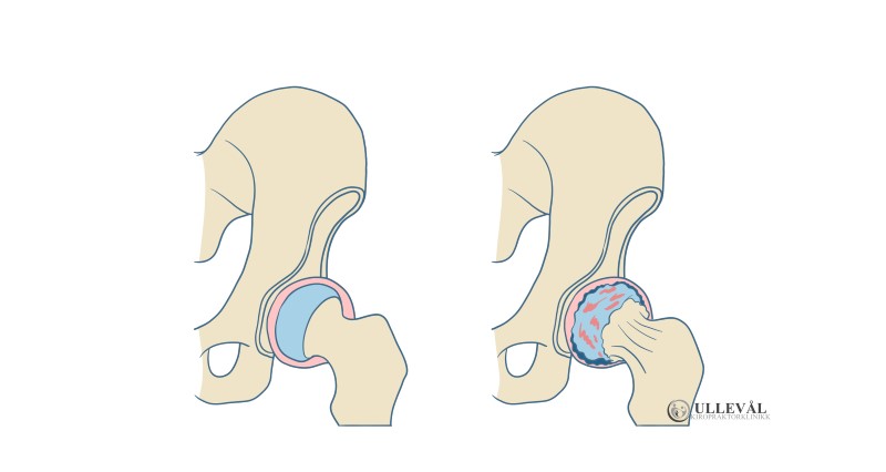 Hofteartrose hofteslitasje
artrose slitasje