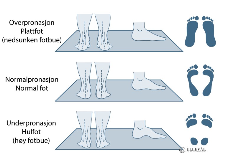 illustrasjon av under- normal og overpronasjon