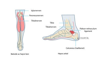 Image: Tarsal tunnel syndrom