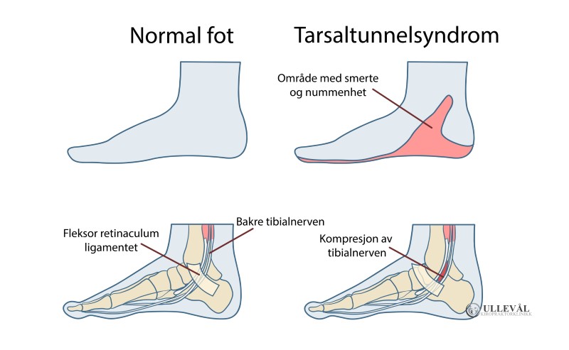 illustrasjon av tarsal tunnel syndrom