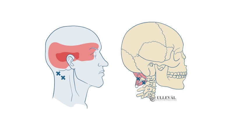 triggerpunktsbilde suboccipitalis med referert smerter
