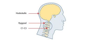 Image: Hva er cervikogen hodepine og hvordan behandles den?